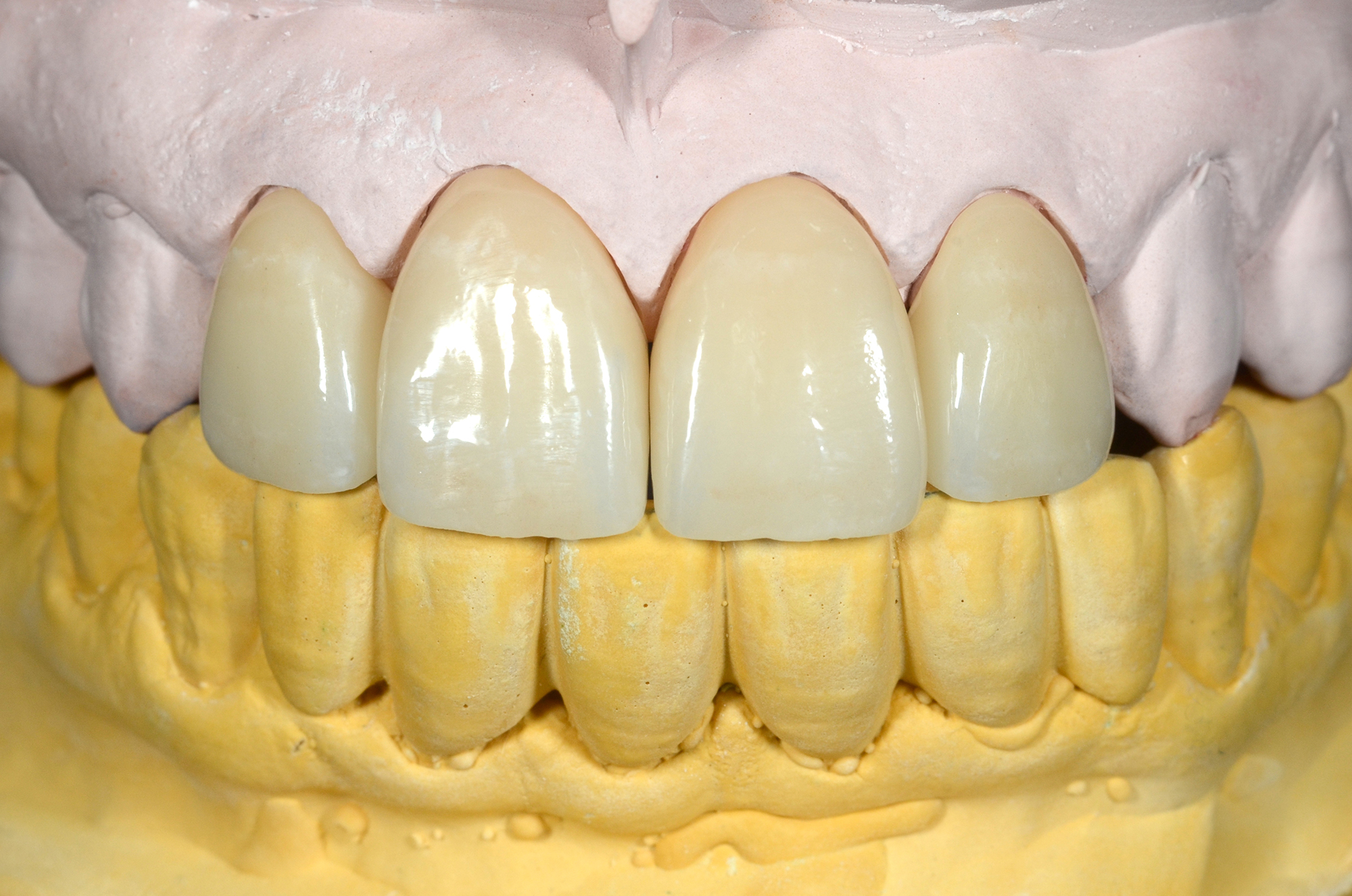 Zirconia Crowns